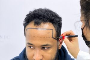 Your Personal Hair Transplant Journey
